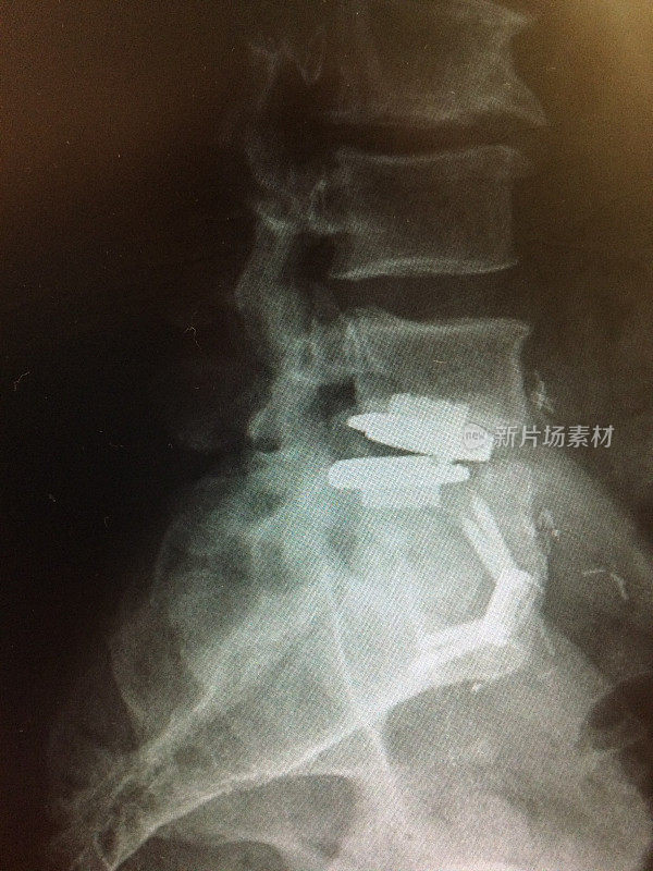 L4-5水平侧位人工椎间盘置换术失败