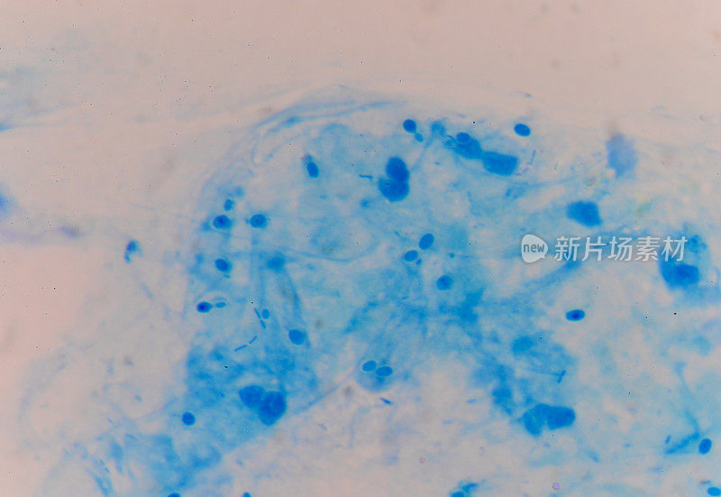革兰氏染色f中带有假菌丝的分枝芽殖酵母细胞