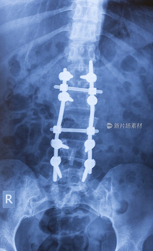 腰骶椎x线片