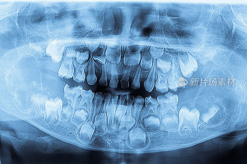牙齿X光片