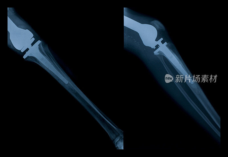 胫骨和腓骨x线照片