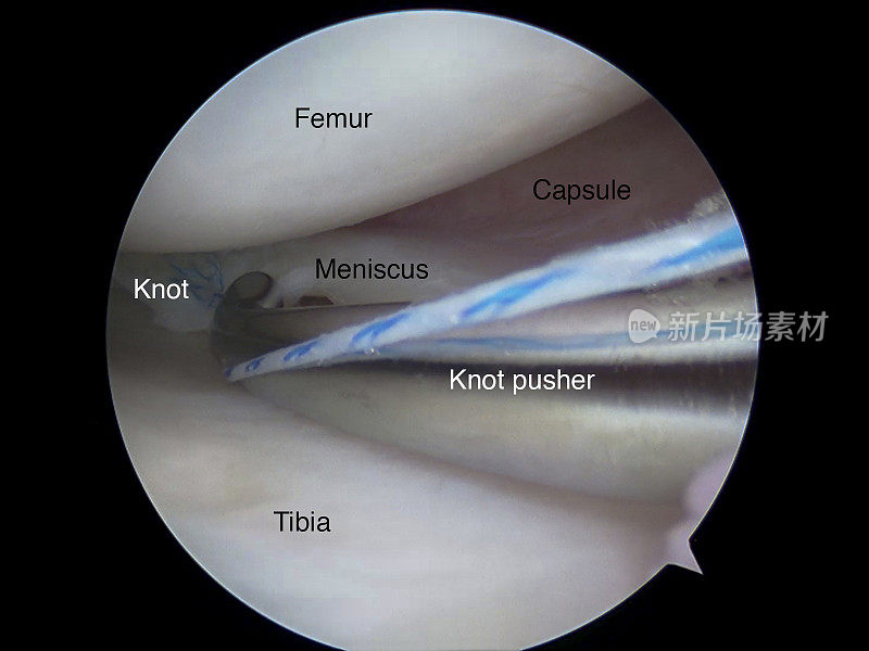 全内半月板缝合锚钉修复的关节镜观察