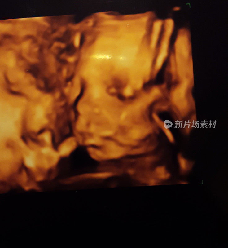 孕期超声监视器彩色图像