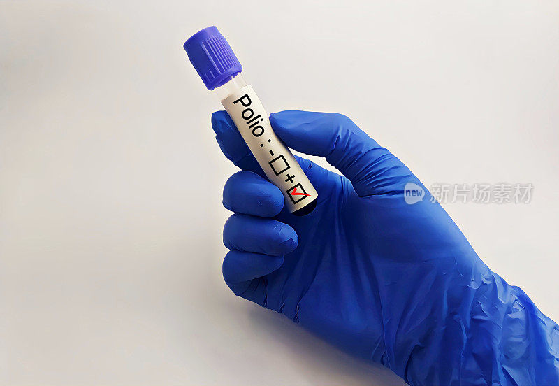 手里拿着阳性脊髓灰质炎病毒检测结果的科学家或医务工作者。