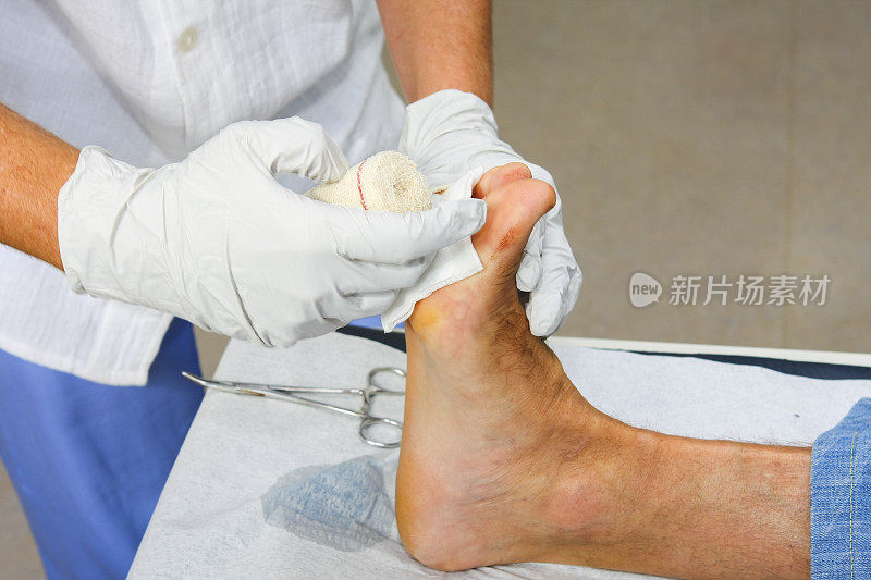 护士正在给一个受伤病人的脚换绷带
