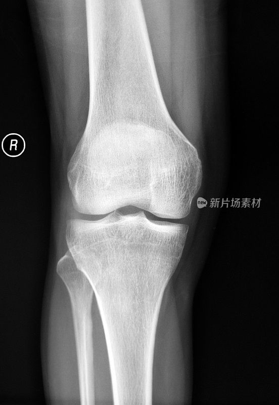 膝盖x光片