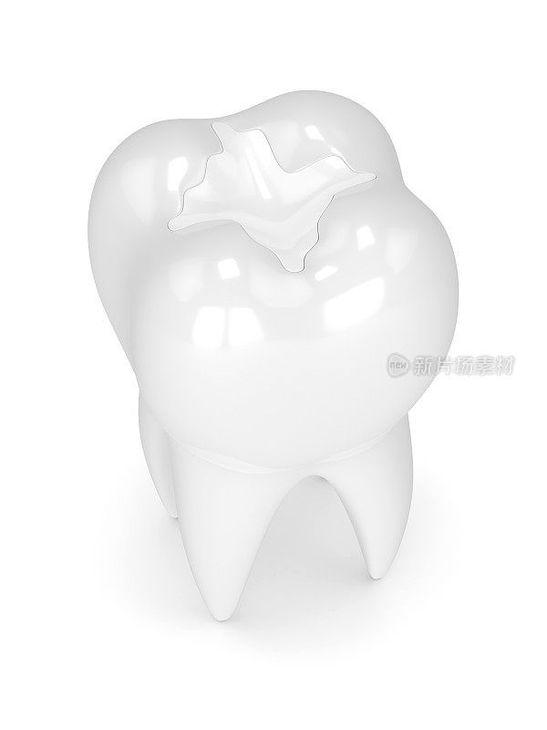 牙齿的3d渲染与牙科复合填充