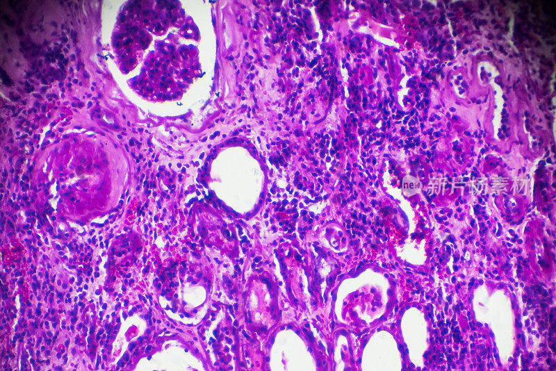 显微镜下硬化性肾小球肾炎活检标本