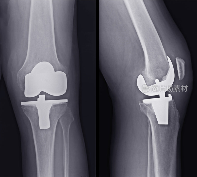 全膝关节置换术假体