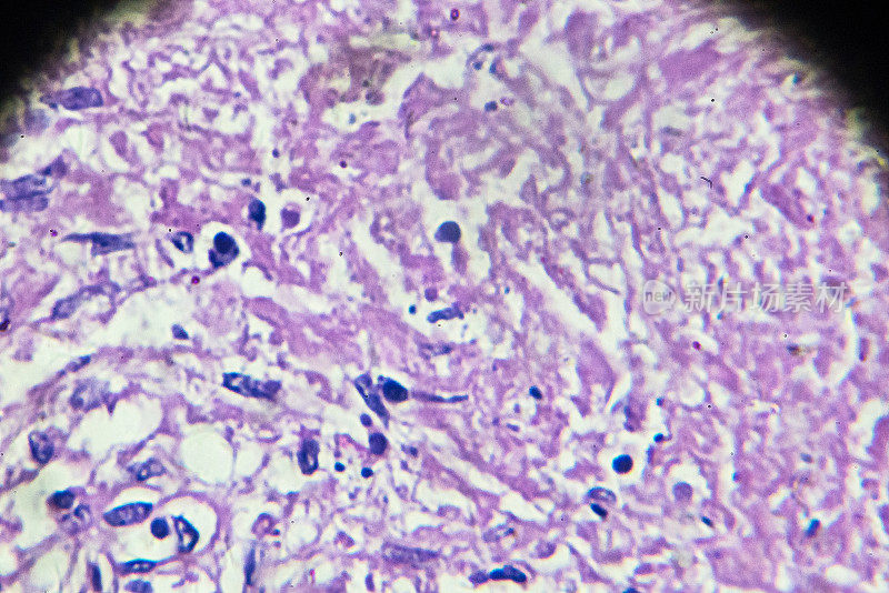 显微镜下人类粟粒结核活检片