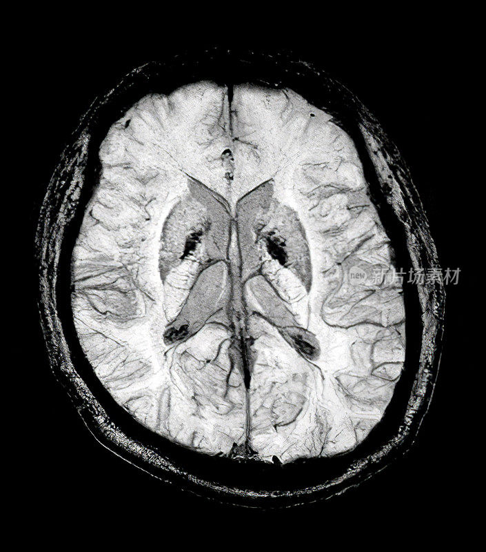 磁共振成像脑部扫描图像(MRI)