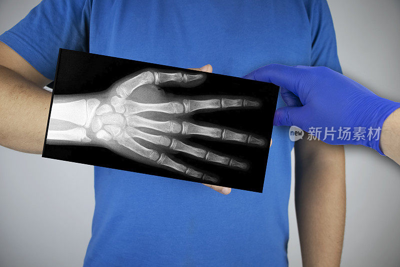 一个男人手腕的x光片。把手指和手的照片放在病人的手上。放射科医生检查x光片。