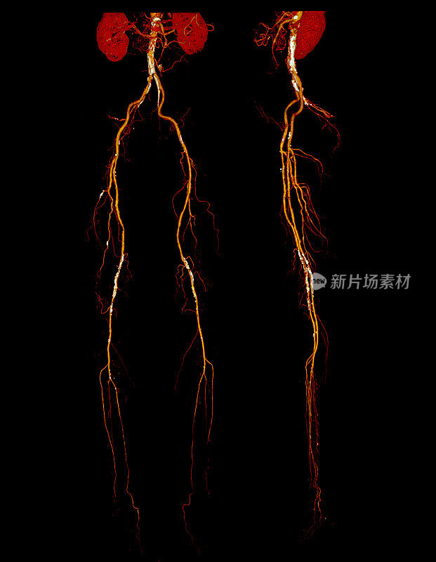 CTA股动脉断流3D显像i。