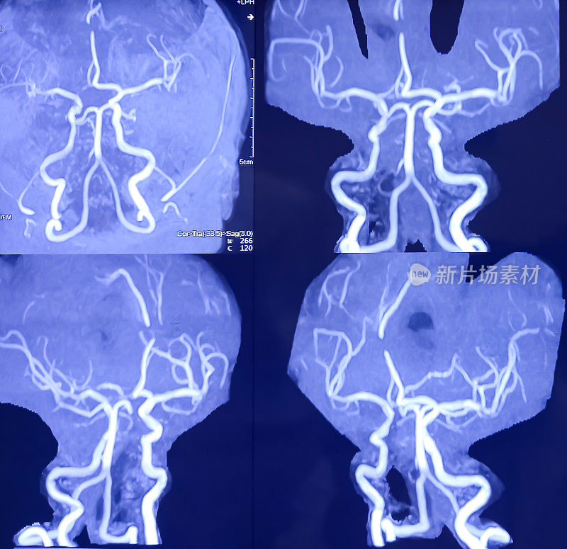 脑核磁共振成像和核磁共振成像。脑部显示脑软化伴广泛胶质增生及左额叶凸出病变。