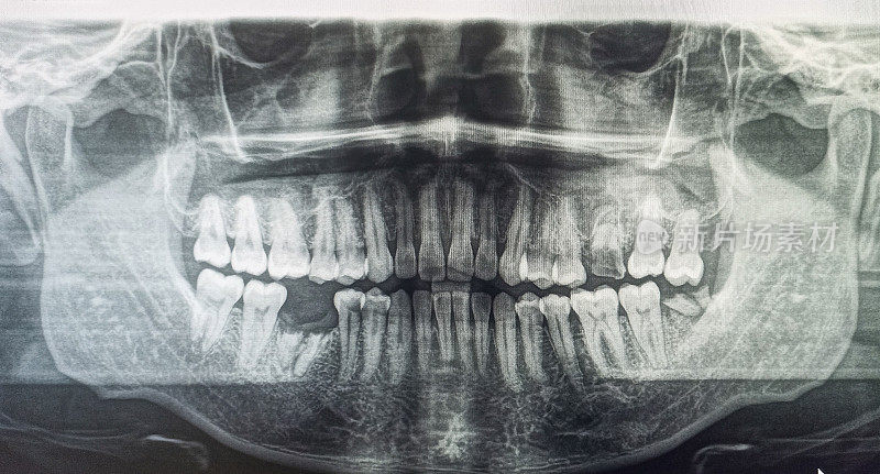 剩余牙根x线扫描图。