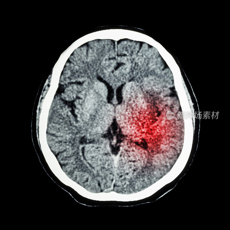 脑CT扫描显示出缺血性卒中或出血性卒中