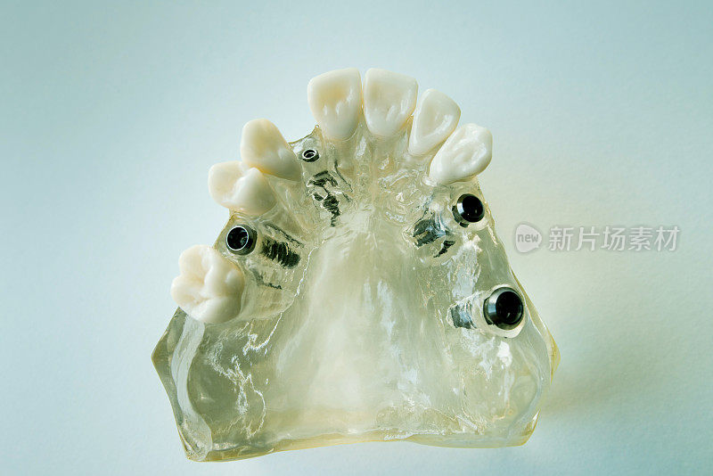 牙科植体模型