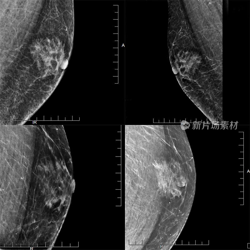 显示男性男性乳房发育(良性肿瘤)的四张乳房x线照片。