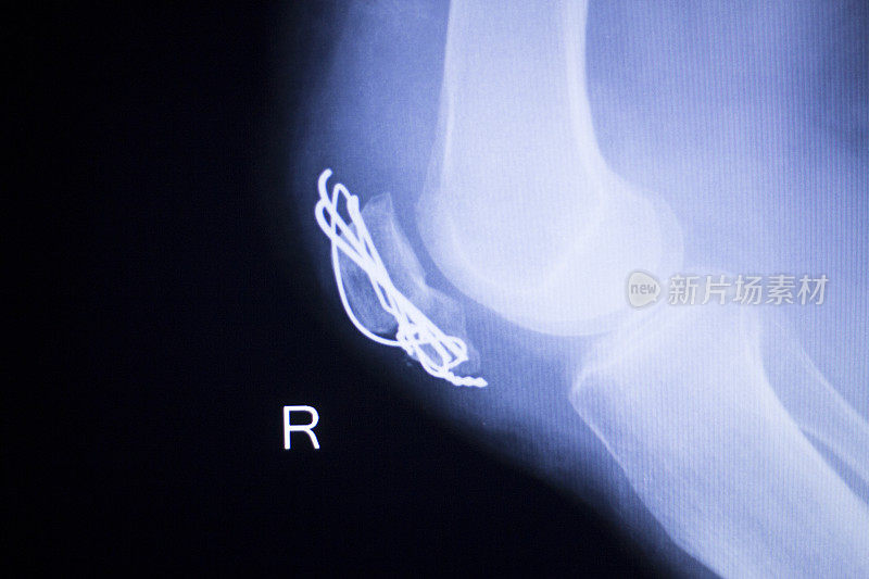医用骨科创伤学扫描显示膝关节植入物螺钉x线。