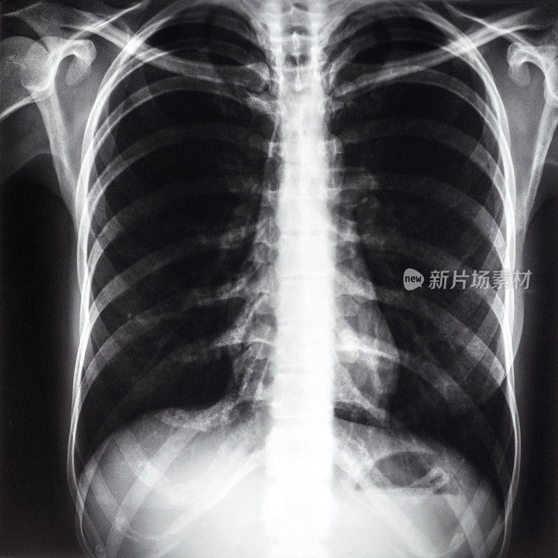 人体胸部的x光影像