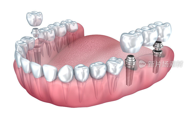 3D渲染:下牙和植牙