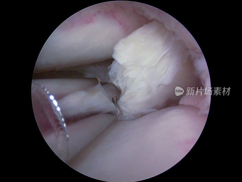 膝关节内侧半月板皮瓣撕裂的关节镜观察