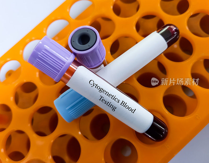 细胞遗传学血液检测的血液样本对某些白血病的特定基因突变的血液进行染色体分析。DNA分析，染色体检测。