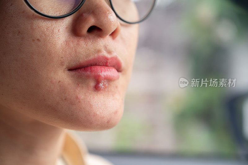 女性下唇发生唇疱疹闭合。水泡破裂形成小溃疡，淋巴结肿大。
