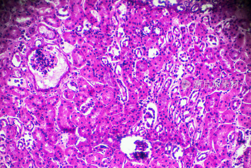 显微镜下急性肾盂肾炎活检标本