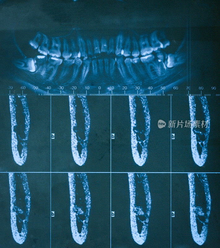人类牙齿特写x光片
