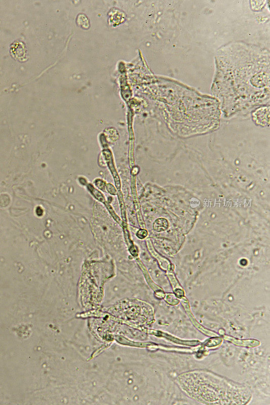 尿中的假菌丝和芽殖酵母细胞