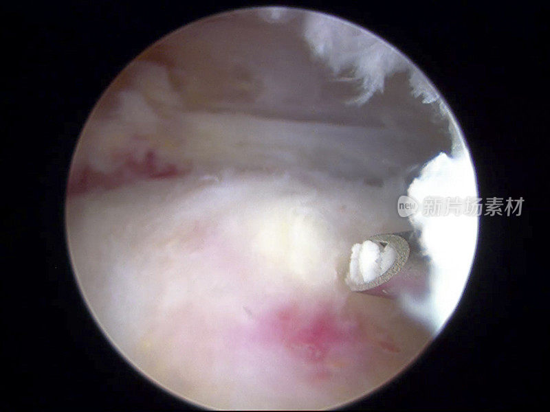 肩关节镜下观察肩关节肌腱的钙沉积