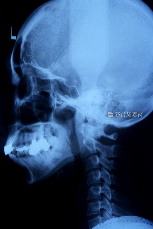 人类头骨的x光侧面图