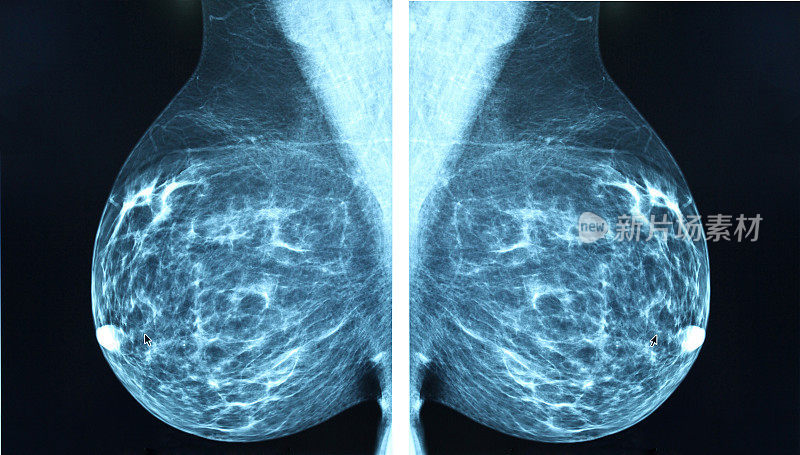 乳房x线放射成像仪诊断乳腺癌