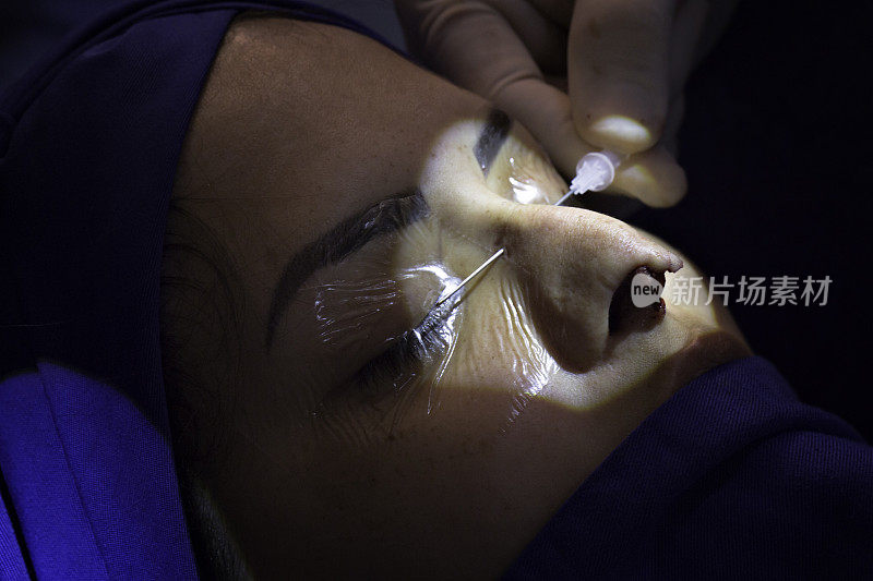 女性患者鼻中隔偏曲及鼻整形手术