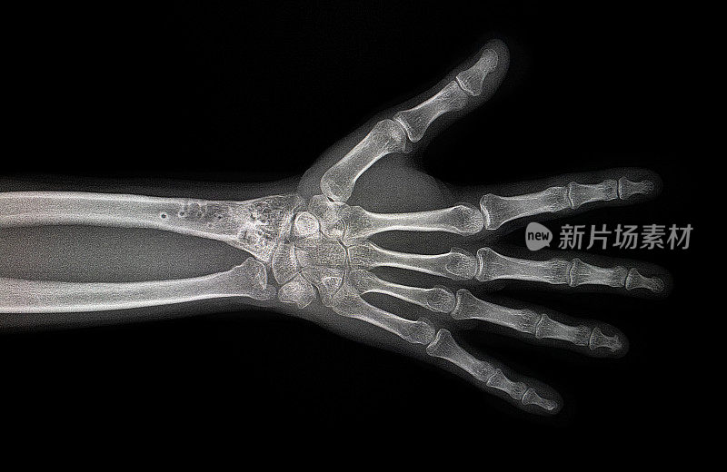手部x光片退行性骨关节炎