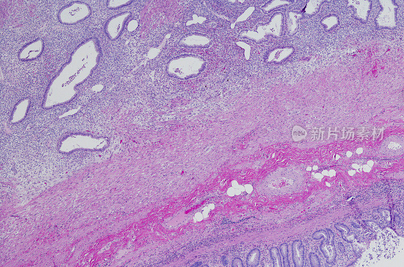 阑尾子宫内膜异位症的显微照片