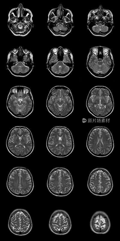 大脑核磁共振