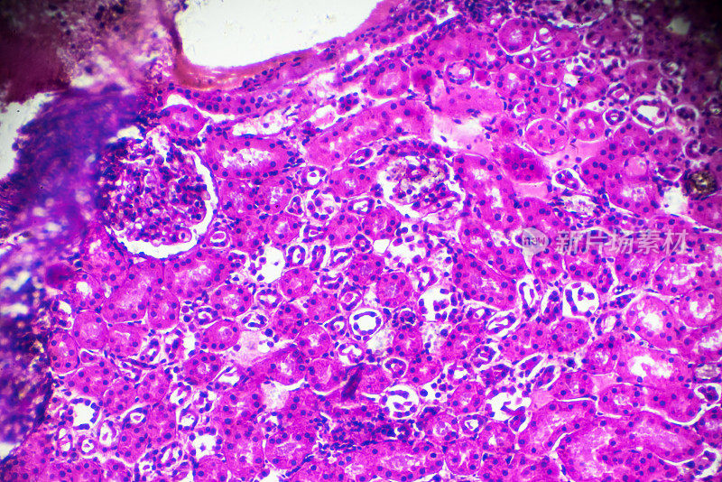 显微镜下急性肾盂肾炎活检标本