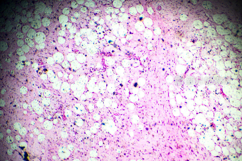脂肪肉瘤镜检活检