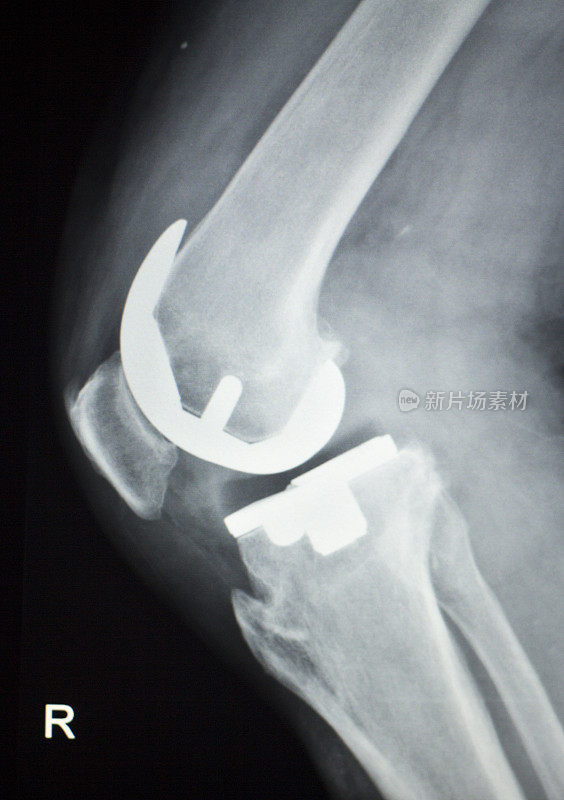 老年患者膝关节置换术骨科钛金属球窝植入物x线影像。