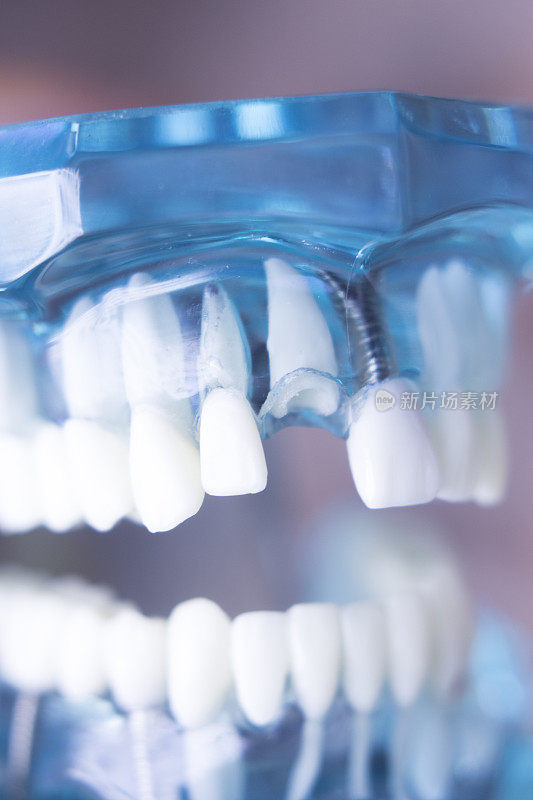 牙科医生进行假牙、牙龈、牙根的教学，让学生模拟门牙有间隙的情况。