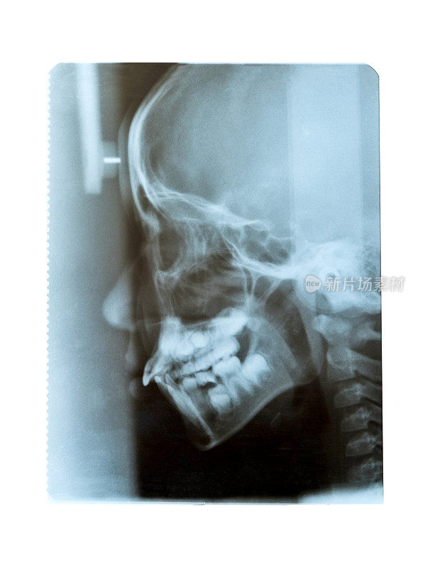 牙科x光片，白色背景