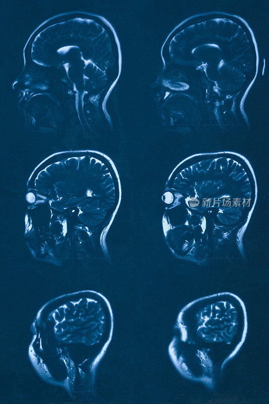 MRI扫描人类头部断层扫描