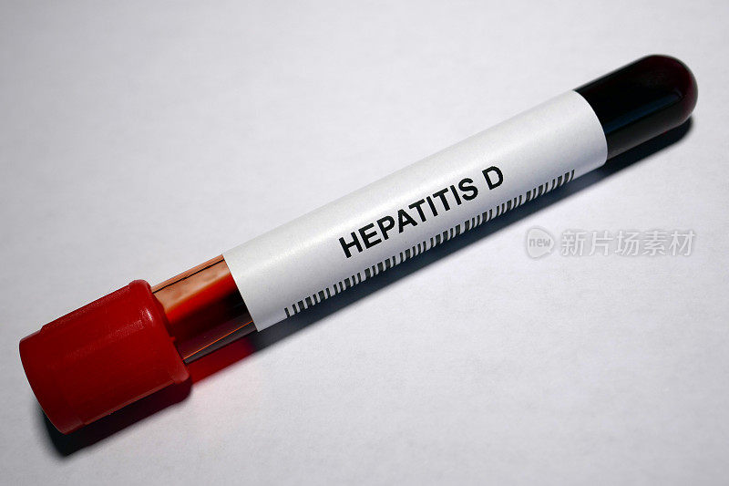 D型肝炎