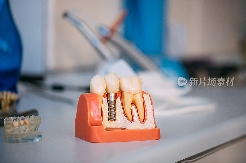 牙科诊所的牙齿模型