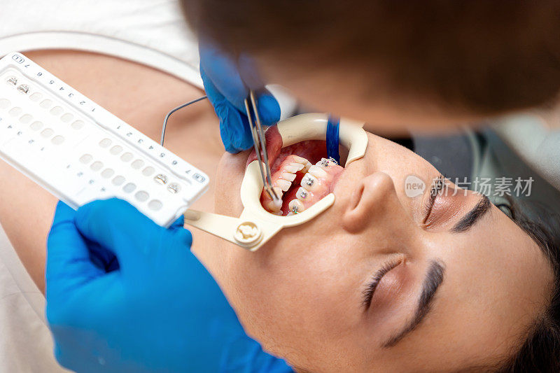 年轻女子在牙科治疗时的特写。正畸医师为病人固定牙套。正畸学的概念