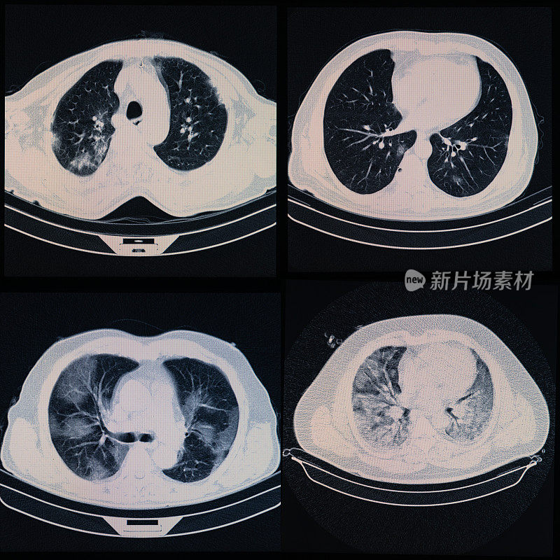 医用x射线图像上Covid-19的变化