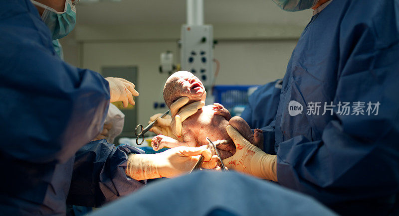 剖腹产通过剖腹产出生的婴儿