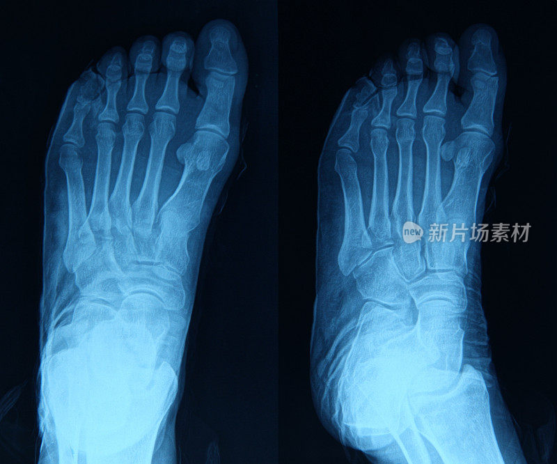 足部的x光图像
